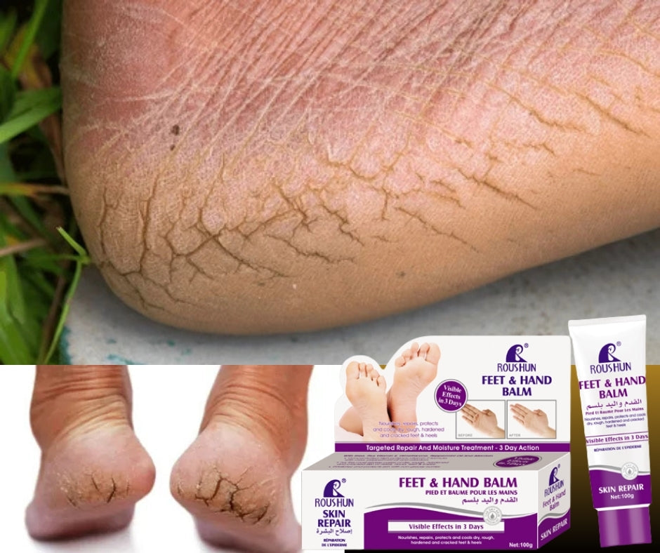 CREAM anti-fissures de Pieds et les mains durs