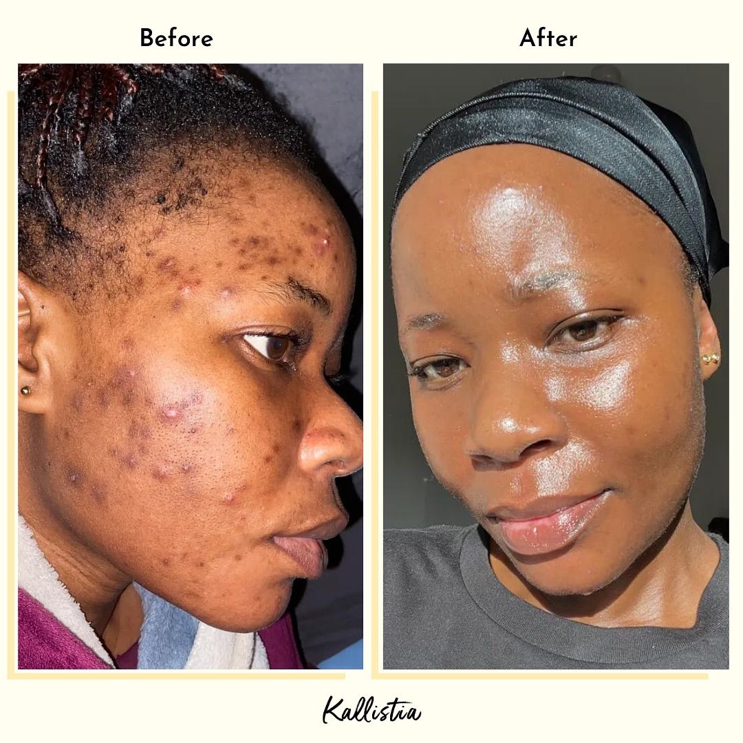 Crème Anti-Acné & Anti-Taches