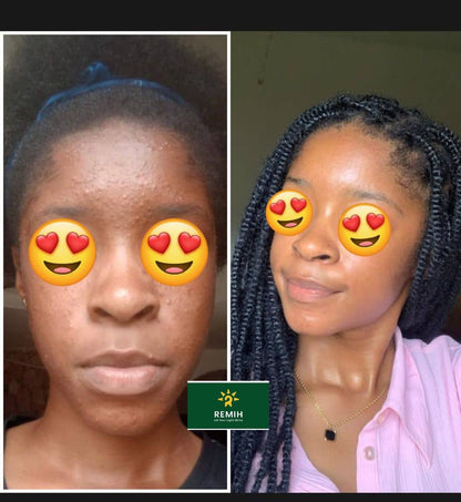 Crème Anti-Acné & Anti-Taches