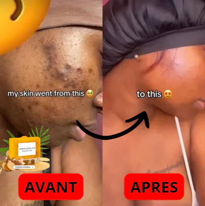 SOAP™: Le Savon Anti-Acné Curcuma & Kojic