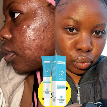 Crème Anti-Acné & Anti-Taches