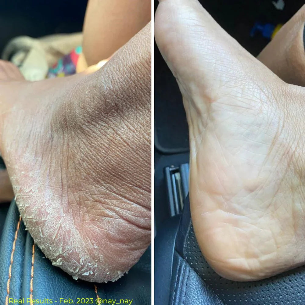 CREAM anti-fissures de Pieds et les mains durs