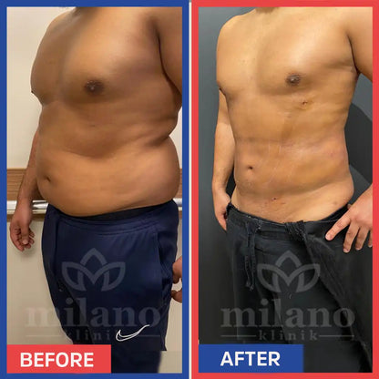 Slim patch amincissant, meilleurs résultats.