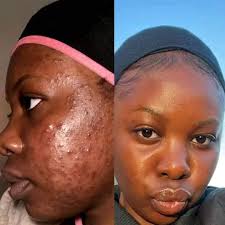 Crème Anti-Acné & Anti-Taches